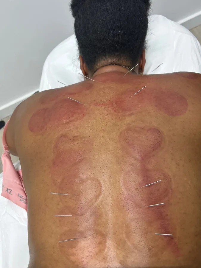 Cupping marks and acupuncture needles across a patient's upper back